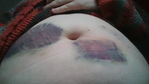 bruise